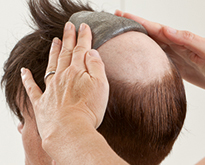 the adhesive force of ContactSkin holds more secure than alternative toupees